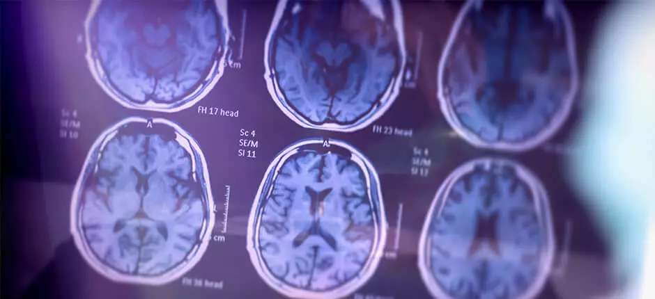 Ataque cerebrovascular: ¿sabes cómo reconocerlo y qué hacer?