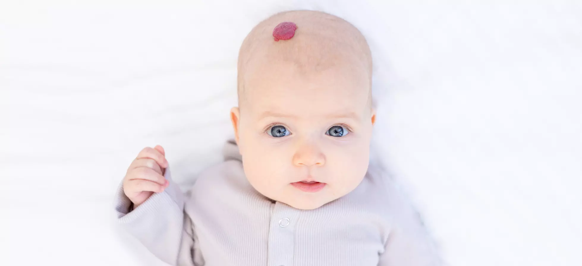 Hemangiomas infantiles: todo sobre las marcas de nacimiento