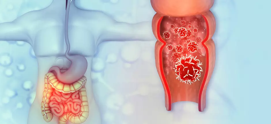 Cáncer colorrectal: se han duplicado los casos en menores de 50 años