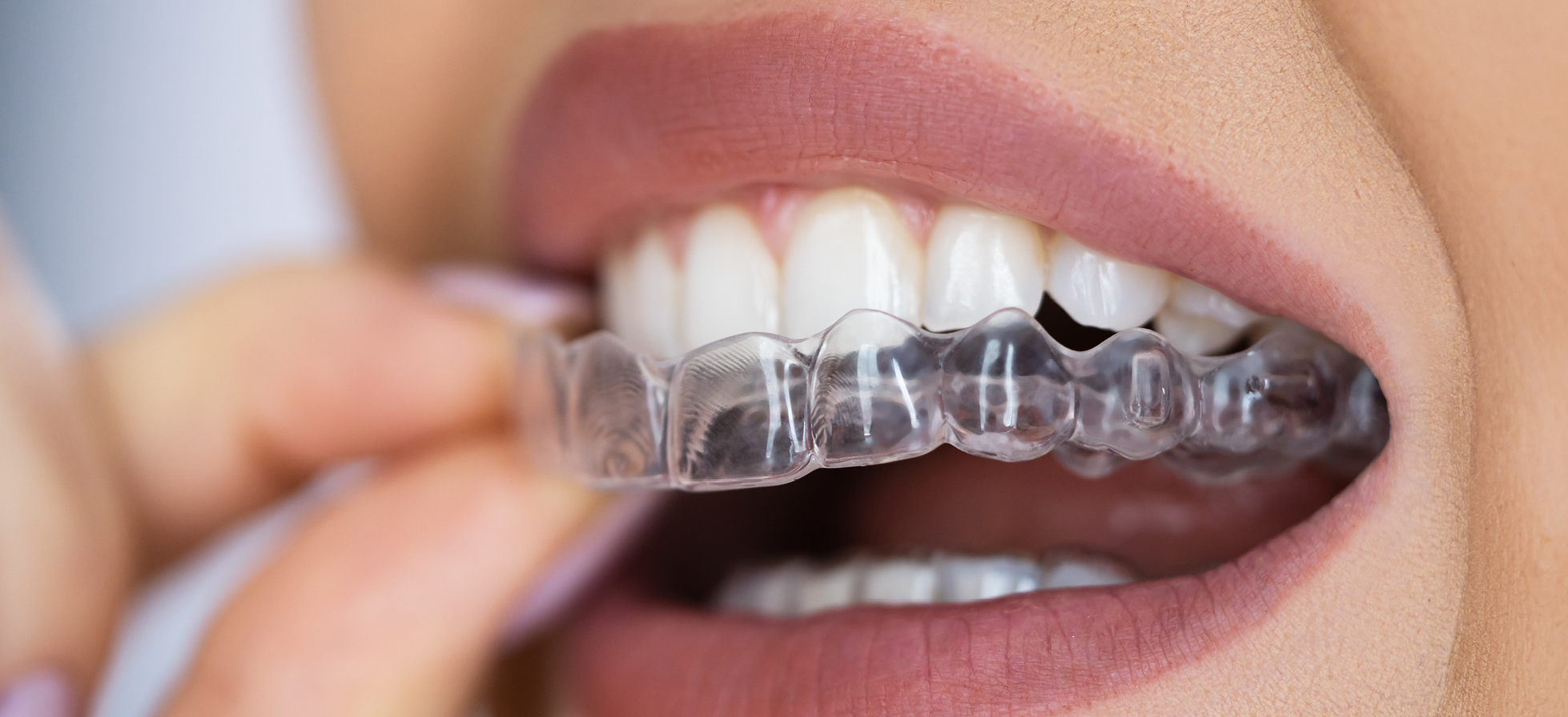 Alineamiento dental: cómo la ortodoncia invisible está transformando las sonrisas