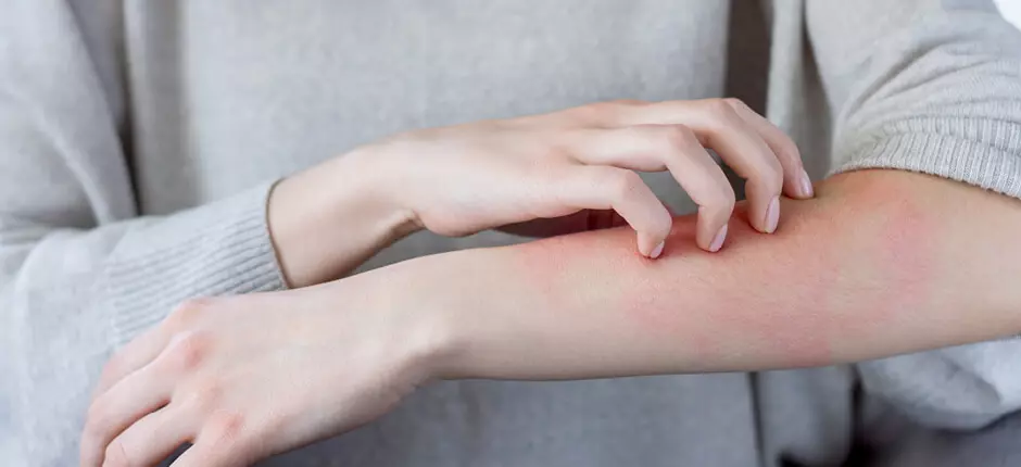 Remedios que enferman: cuando se tiene alergia a un medicamento