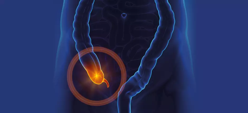 ¿Este dolor será apendicitis?