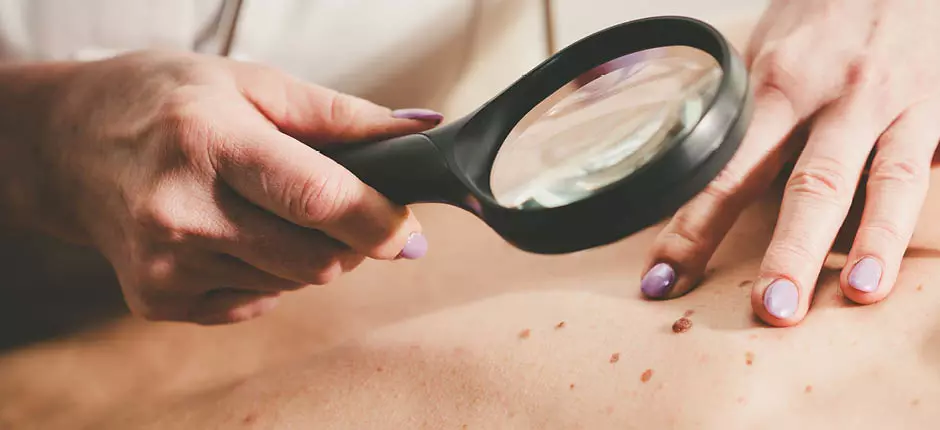 Cirugía de Mohs: la mejor opción para el cáncer de piel no melanoma