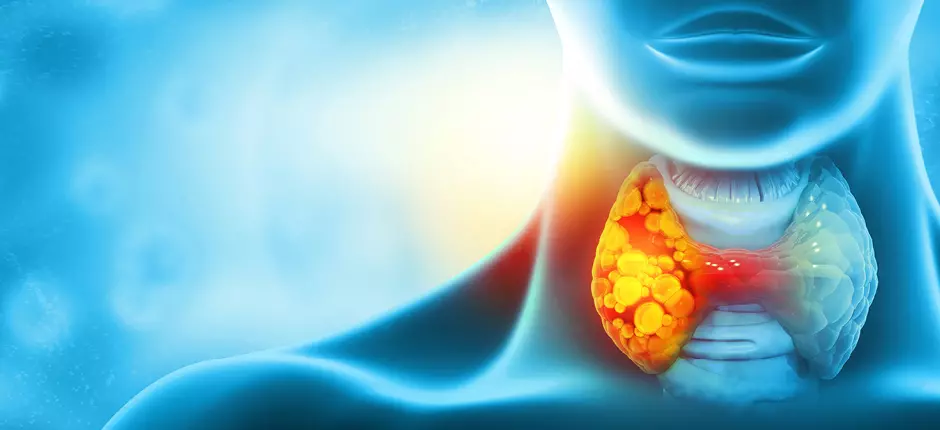 Cáncer de tiroides: ¿cuándo sospecharlo?