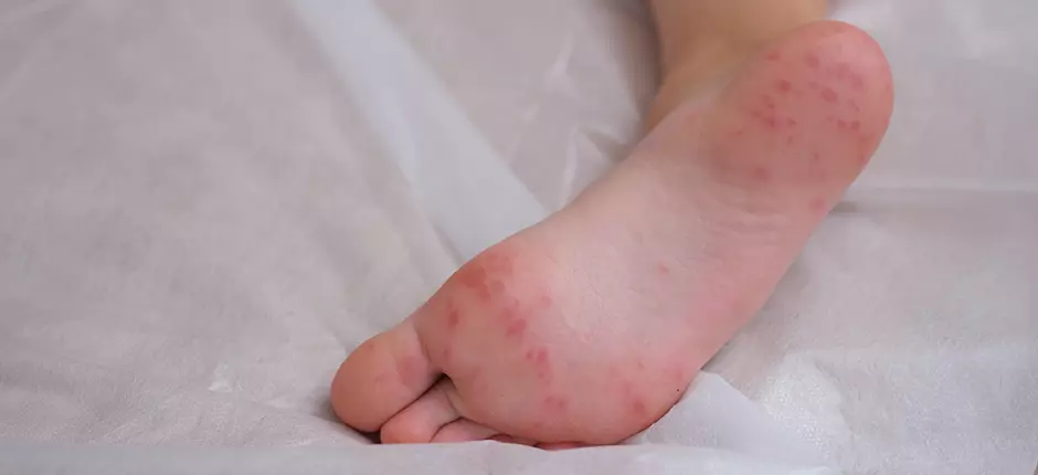 Pie, mano, boca: molesta enfermedad infecciosa que afecta a niños