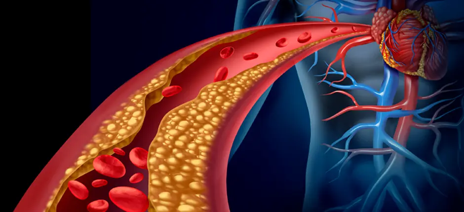 Diferencias entre el colesterol malo y el colesterol bueno
