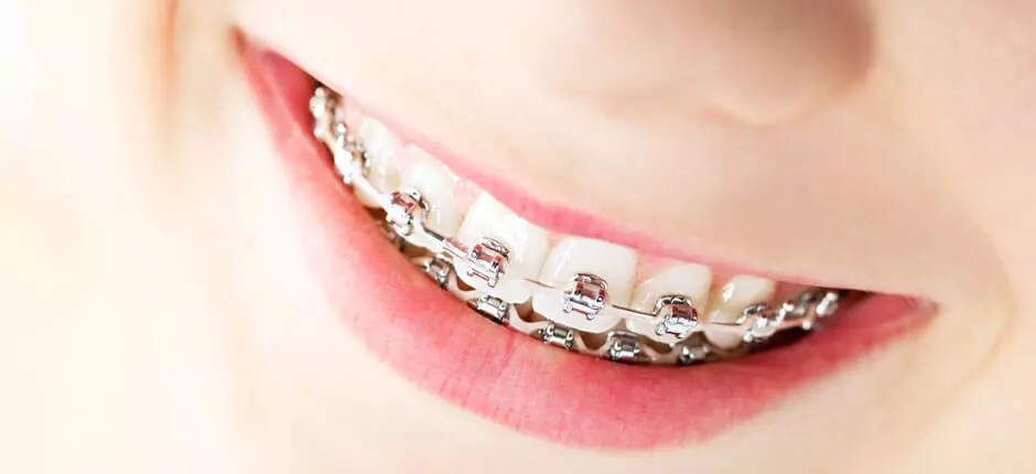 ¿Cuál es la edad ideal para poner frenillos?