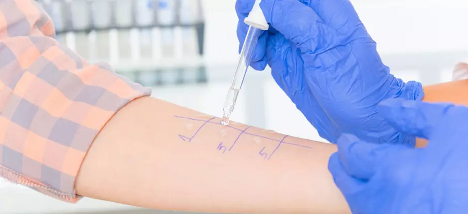 Prick test: ¿a qué le tengo alergia?